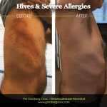 Hives before and after