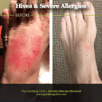 Hives before and after