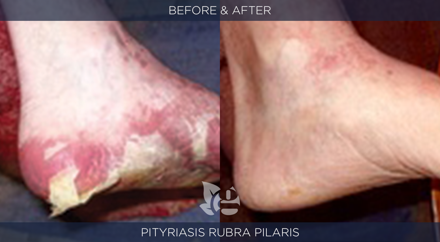 Pityriasis Before and After