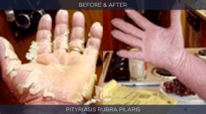 Pityriasis rubra pilaris before and after