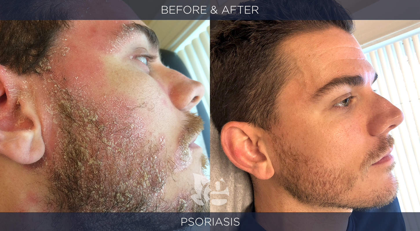 Psoriasis Before and After