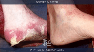Pityriasis Before & After
