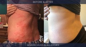 Hives Before and After
