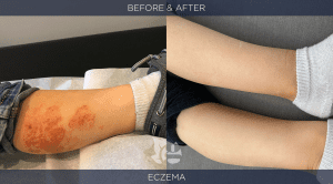 Eczema before and after