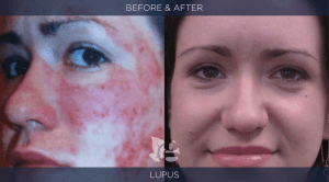 Lupus Before and After