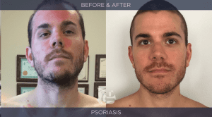 Psoriasis before and after