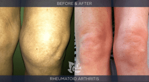 Rheumatoid Arthritis before and after