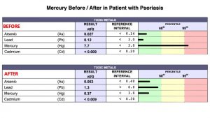 Mercury Toxicity Before and After