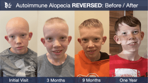 Autoimmune Alopecia Before and After