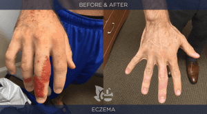 Eczema before and after