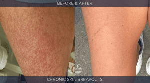 Skin Rash Before / After