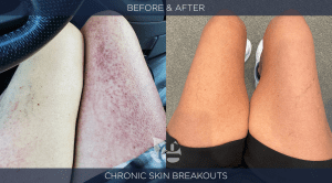 Skin Rash Before and After