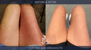 Skin Rash Before and After
