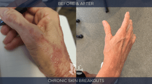 Skin Rash before and after
