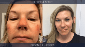 chronic allergies before and after