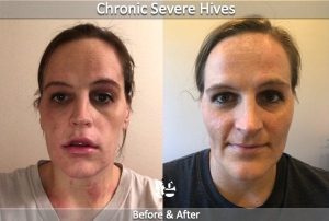 hives and allergies before and after